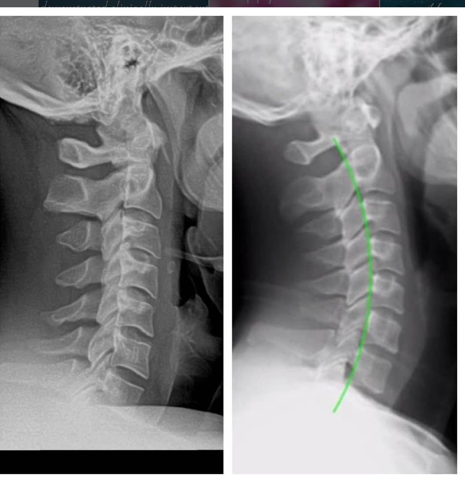 Cervical spine X-ray analysis used in the Gonstead System